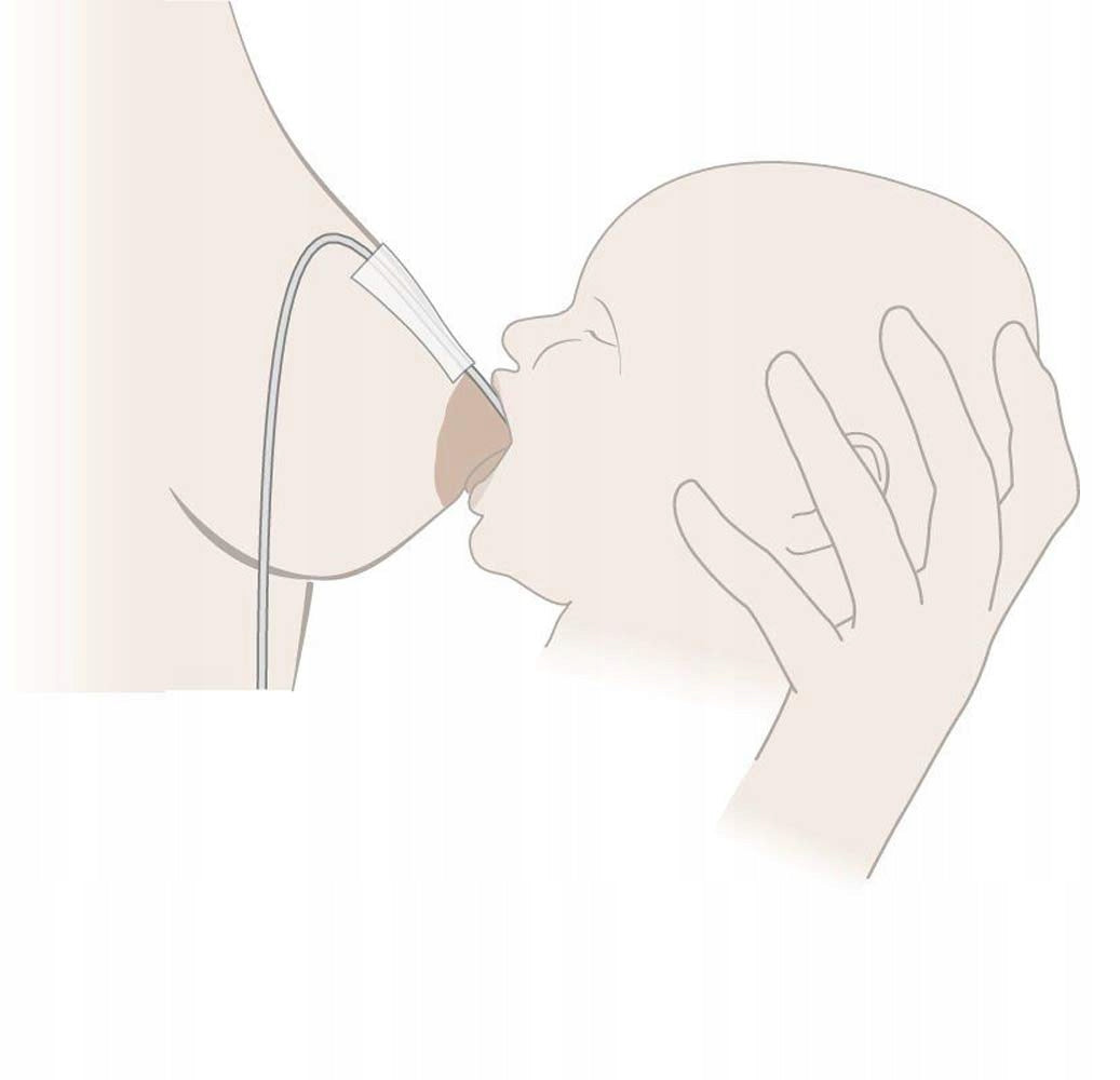 Medela Brusternährungsset (SNS)